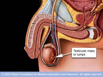 testicular cancer