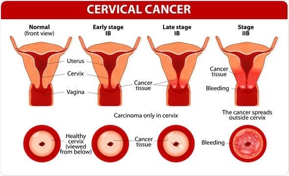 stages of cervical cancer